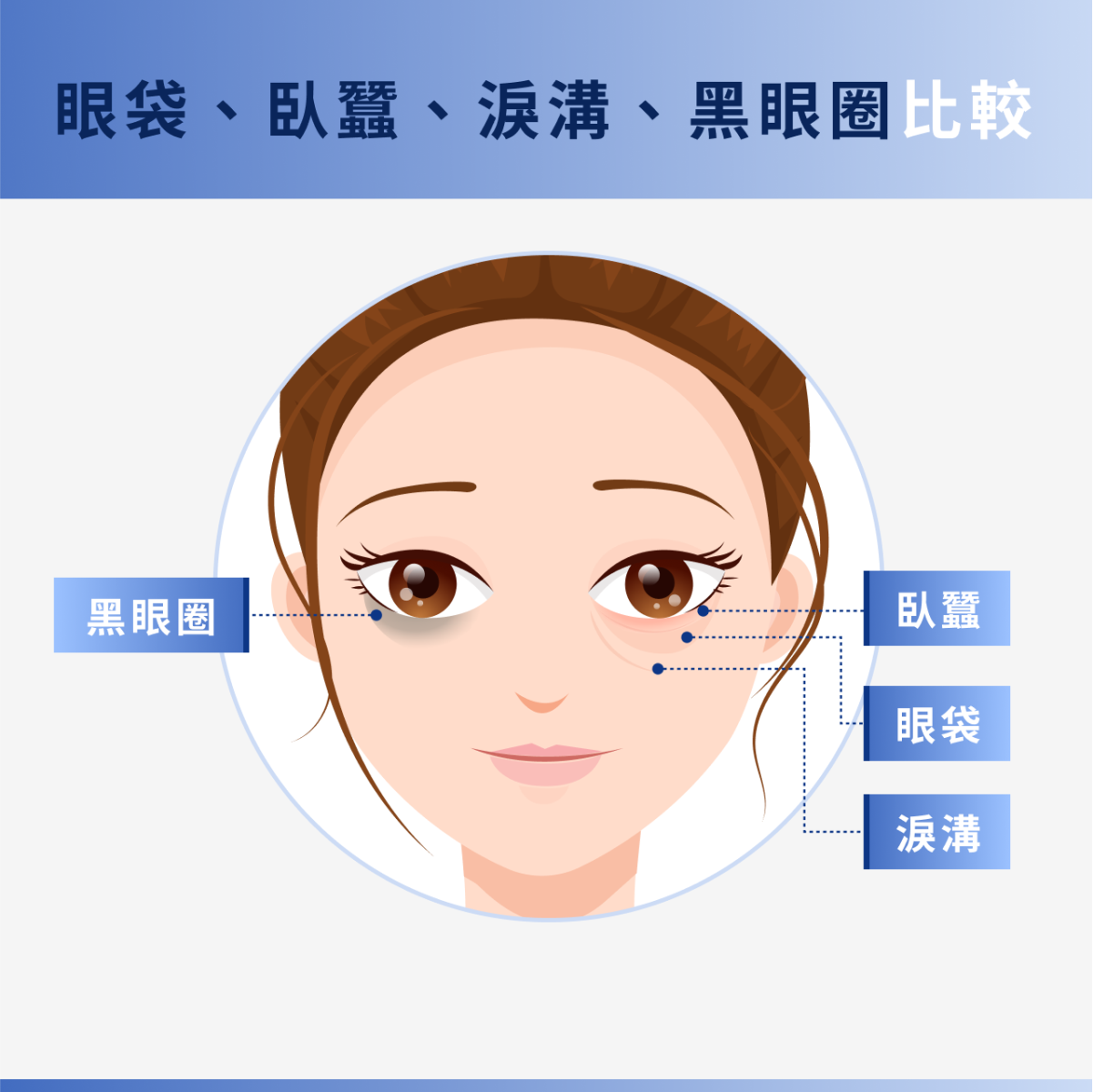 淚溝、眼袋、臥蠶、黑眼圈位置示意圖